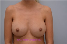 Breast Augmentation After Photo by G. Robert Meger, MD; Scottsdale, AZ - Case 34691