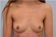 Breast Augmentation Before Photo by G. Robert Meger, MD; Scottsdale, AZ - Case 34691