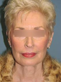 Facelift After Photo by Lisa Taylor, MD; Oklahoma City, OK - Case 9727