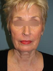 Facelift Before Photo by Lisa Taylor, MD; Oklahoma City, OK - Case 9727