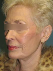Facelift After Photo by Lisa Taylor, MD; Oklahoma City, OK - Case 9727