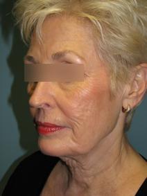 Facelift Before Photo by Lisa Taylor, MD; Oklahoma City, OK - Case 9727