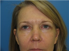 Eyelid Surgery After Photo by William LoVerme, MD; Sudbury, MA - Case 20129