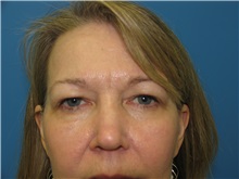 Eyelid Surgery Before Photo by William LoVerme, MD; Sudbury, MA - Case 20129