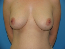 Breast Augmentation After Photo by William LoVerme, MD; Sudbury, MA - Case 20130