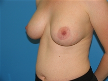 Breast Augmentation Before Photo by William LoVerme, MD; Sudbury, MA - Case 20130