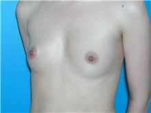 Breast Augmentation Before Photo by William LoVerme, MD; Sudbury, MA - Case 20132