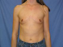 Breast Augmentation Before Photo by York Yates, MD; Layton, UT - Case 7741