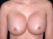 Breast Augmentation After Photo by Michele DeVito, MD FACS; Scottsdale, AZ - Case 10002