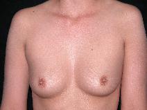 Breast Augmentation Before Photo by Michele DeVito, MD FACS; Scottsdale, AZ - Case 10002