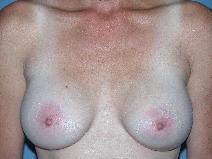 Breast Augmentation After Photo by Michele DeVito, MD FACS; Scottsdale, AZ - Case 10160