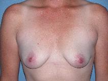 Breast Augmentation Before Photo by Michele DeVito, MD FACS; Scottsdale, AZ - Case 10160