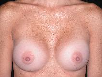 Breast Augmentation After Photo by Michele DeVito, MD FACS; Scottsdale, AZ - Case 10182