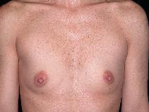 Breast Augmentation Before Photo by Michele DeVito, MD FACS; Scottsdale, AZ - Case 10182