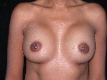 Breast Augmentation After Photo by Michele DeVito, MD FACS; Scottsdale, AZ - Case 10183