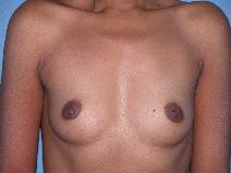 Breast Augmentation Before Photo by Michele DeVito, MD FACS; Scottsdale, AZ - Case 10183