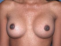 Breast Augmentation After Photo by Michele DeVito, MD FACS; Scottsdale, AZ - Case 10185