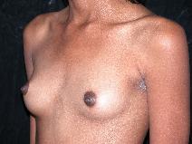 Breast Augmentation Before Photo by Michele DeVito, MD FACS; Scottsdale, AZ - Case 10185