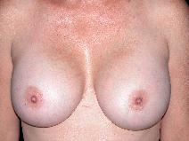 Breast Augmentation After Photo by Michele DeVito, MD FACS; Scottsdale, AZ - Case 10186