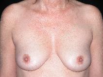 Breast Augmentation Before Photo by Michele DeVito, MD FACS; Scottsdale, AZ - Case 10186