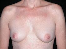 Breast Augmentation After Photo by Michele DeVito, MD FACS; Scottsdale, AZ - Case 10187