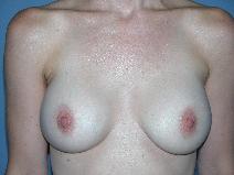 Breast Augmentation Before Photo by Michele DeVito, MD FACS; Scottsdale, AZ - Case 10187