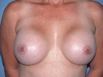 Breast Augmentation After Photo by Michele DeVito, MD FACS; Scottsdale, AZ - Case 10188