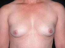 Breast Augmentation Before Photo by Michele DeVito, MD FACS; Scottsdale, AZ - Case 10188