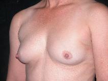 Breast Augmentation After Photo by Michele DeVito, MD FACS; Scottsdale, AZ - Case 10188