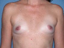 Breast Augmentation Before Photo by Michele DeVito, MD FACS; Scottsdale, AZ - Case 10189