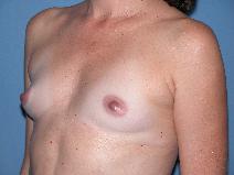 Breast Augmentation Before Photo by Michele DeVito, MD FACS; Scottsdale, AZ - Case 10189