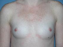 Breast Augmentation Before Photo by Michele DeVito, MD FACS; Scottsdale, AZ - Case 10190
