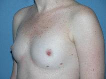 Breast Augmentation Before Photo by Michele DeVito, MD FACS; Scottsdale, AZ - Case 10190
