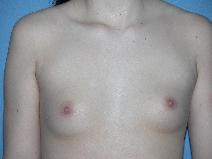 Breast Augmentation Before Photo by Michele DeVito, MD FACS; Scottsdale, AZ - Case 10191