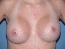 Breast Augmentation Before Photo by Michele DeVito, MD FACS; Scottsdale, AZ - Case 10191