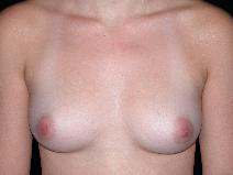 Breast Augmentation Before Photo by Michele DeVito, MD FACS; Scottsdale, AZ - Case 10192