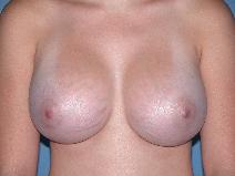 Breast Augmentation Before Photo by Michele DeVito, MD FACS; Scottsdale, AZ - Case 10192