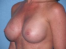 Breast Augmentation After Photo by Michele DeVito, MD FACS; Scottsdale, AZ - Case 9975