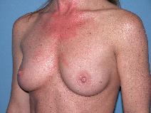 Breast Augmentation Before Photo by Michele DeVito, MD FACS; Scottsdale, AZ - Case 9975