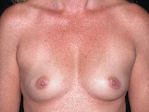 Breast Augmentation Before Photo by Michele DeVito, MD FACS; Scottsdale, AZ - Case 9977