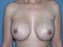 Breast Augmentation After Photo by Michele DeVito, MD FACS; Scottsdale, AZ - Case 9978