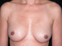 Breast Augmentation Before Photo by Michele DeVito, MD FACS; Scottsdale, AZ - Case 9978