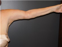 Arm Lift After Photo by Michele DeVito, MD FACS; Scottsdale, AZ - Case 49663