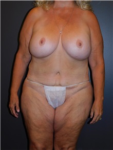 Tummy Tuck After Photo by Michele DeVito, MD FACS; Scottsdale, AZ - Case 49826 Tummy Tuck After Photo by Michele DeVito, MD FACS; Scottsdale, AZ - Case 49826