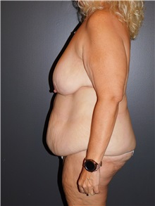 Tummy Tuck Before Photo by Michele DeVito, MD FACS; Scottsdale, AZ - Case 49826