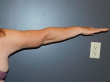 Arm Lift After Photo by Michele DeVito, MD FACS; Scottsdale, AZ - Case 49833 Arm Lift After Photo by Michele DeVito, MD FACS; Scottsdale, AZ - Case 49833