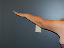 Arm Lift After Photo by Michele DeVito, MD FACS; Scottsdale, AZ - Case 49833