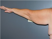 Arm Lift Before Photo by Michele DeVito, MD FACS; Scottsdale, AZ - Case 49833