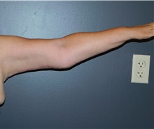 Arm Lift After Photo by Michele DeVito, MD FACS; Scottsdale, AZ - Case 49833