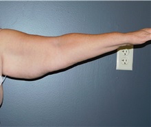 Arm Lift Before Photo by Michele DeVito, MD FACS; Scottsdale, AZ - Case 49833